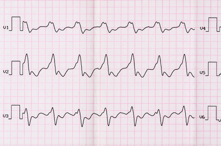 Atrial Fibrillation