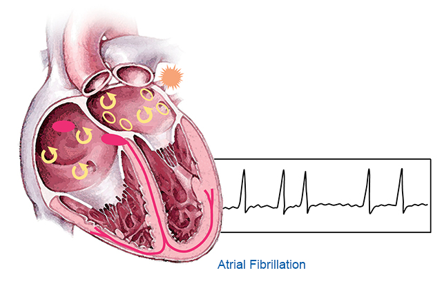 Atrial Fibrillation