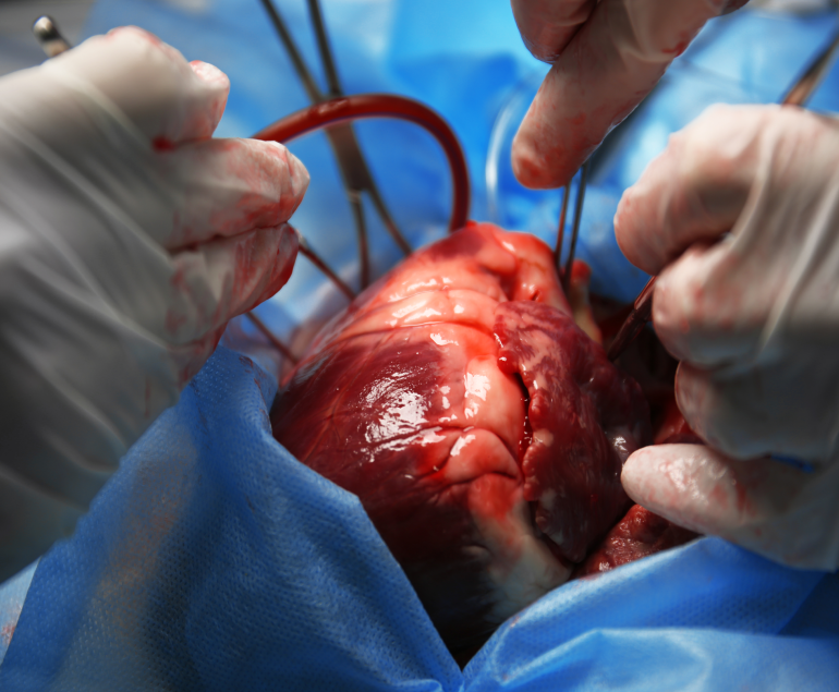 Coronary Artery Bypass Grafting