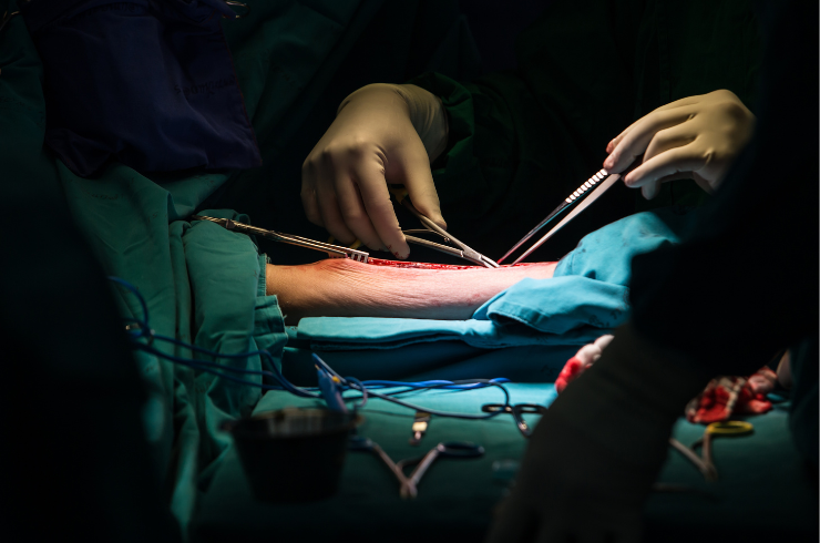 CABG (Coronary Artery Bypass Grafting)